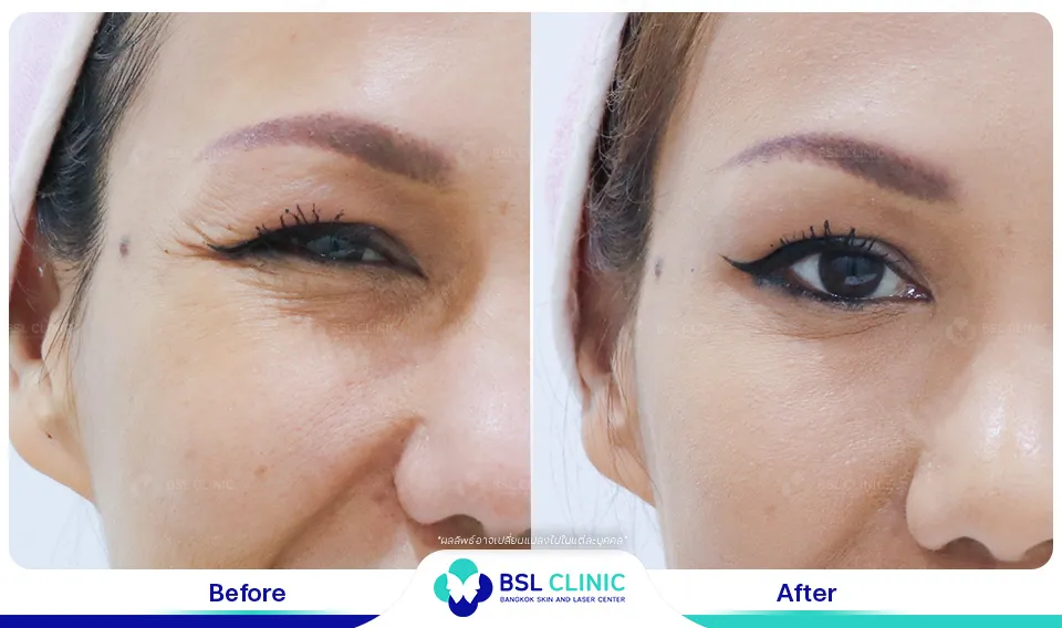 รีวิวลดริ้วรอยร่องแก้ม