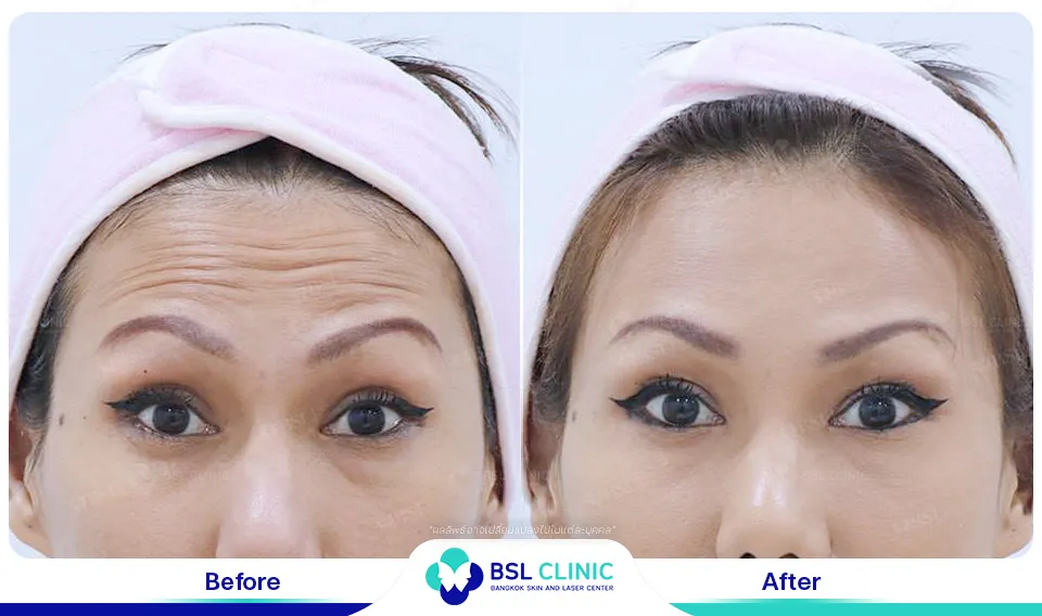 รีวิวเติมเต็มริ้วรอย