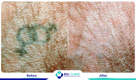 รีวิวลดรอยสัก