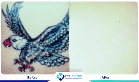 รีวิวลดรอยสัก