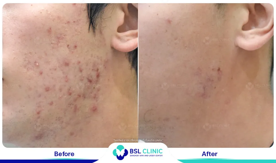 รีวิวรักษาแผลเป็น