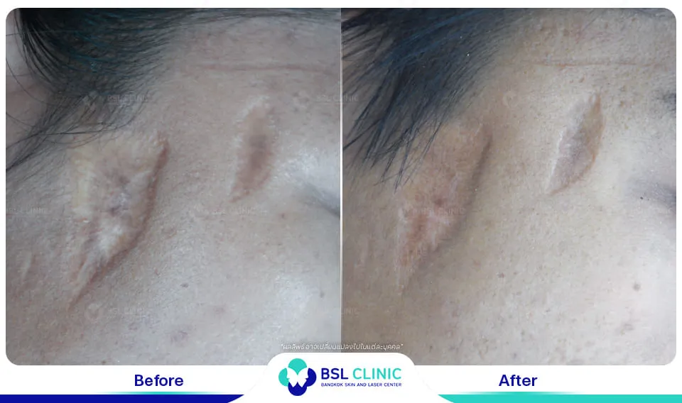 รีวิวรักษาแผลเป็น