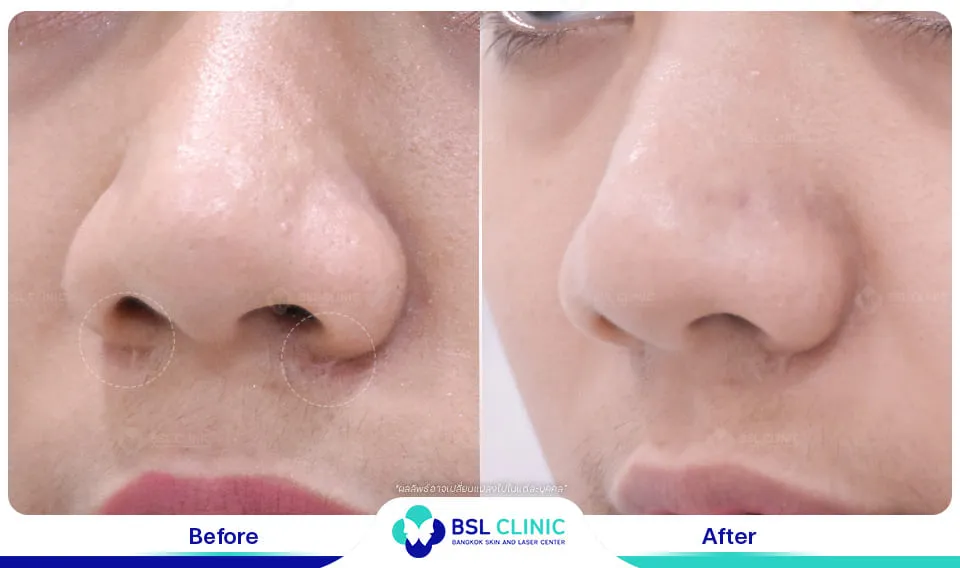 รีวิวรักษาแผลเป็น