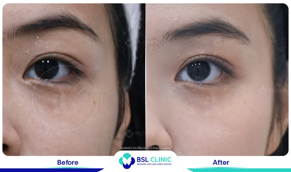 รีวิวรักษาแผลเป็น