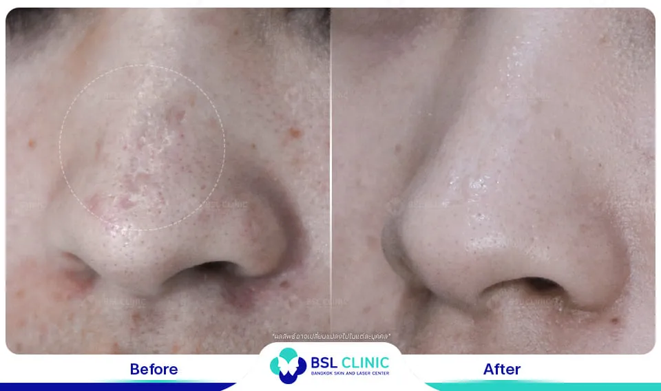 รีวิวรักษารอยแผลเป็น