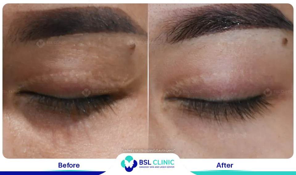 รีวิวรักษารอยแผลเป็น