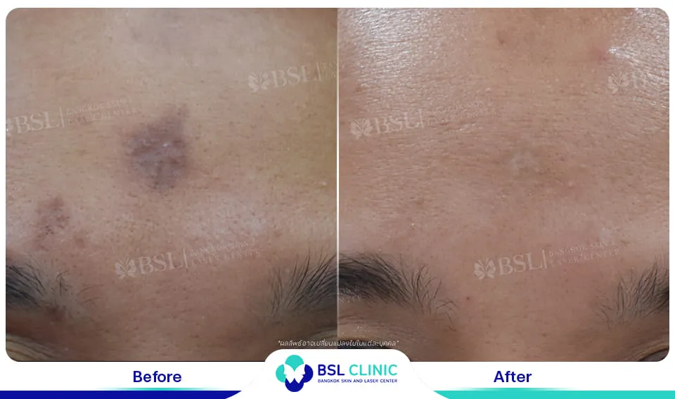 รีวิวรักษารอยแผลเป็น