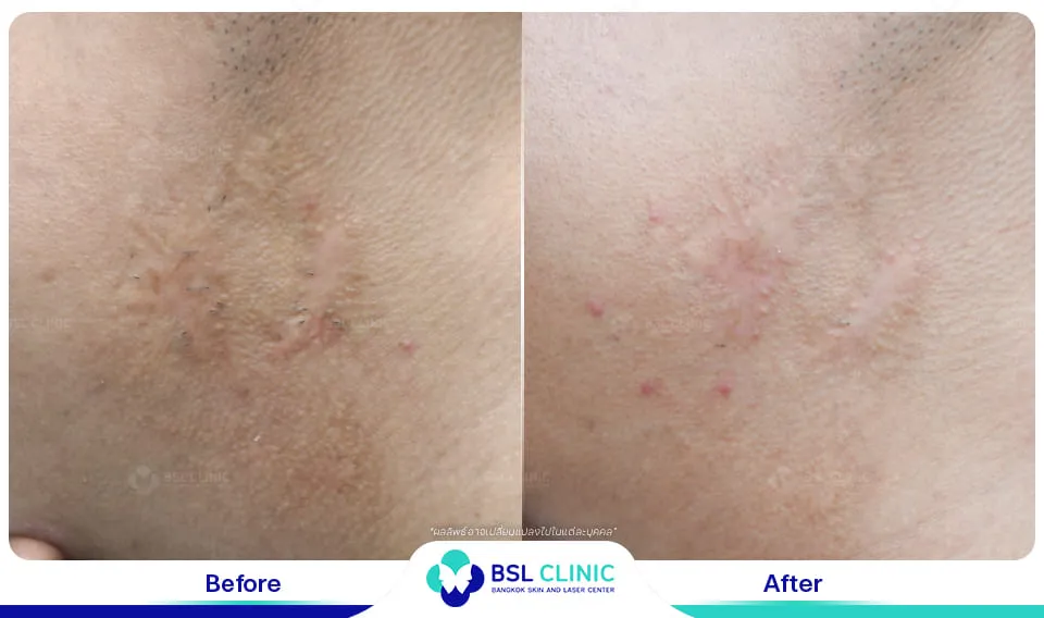 รีวิวรักษารอยแผลเป็น