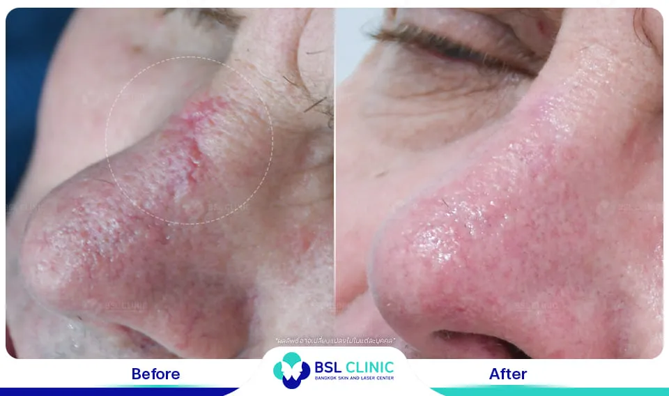 รีวิวรักษารอยแผลเป็น