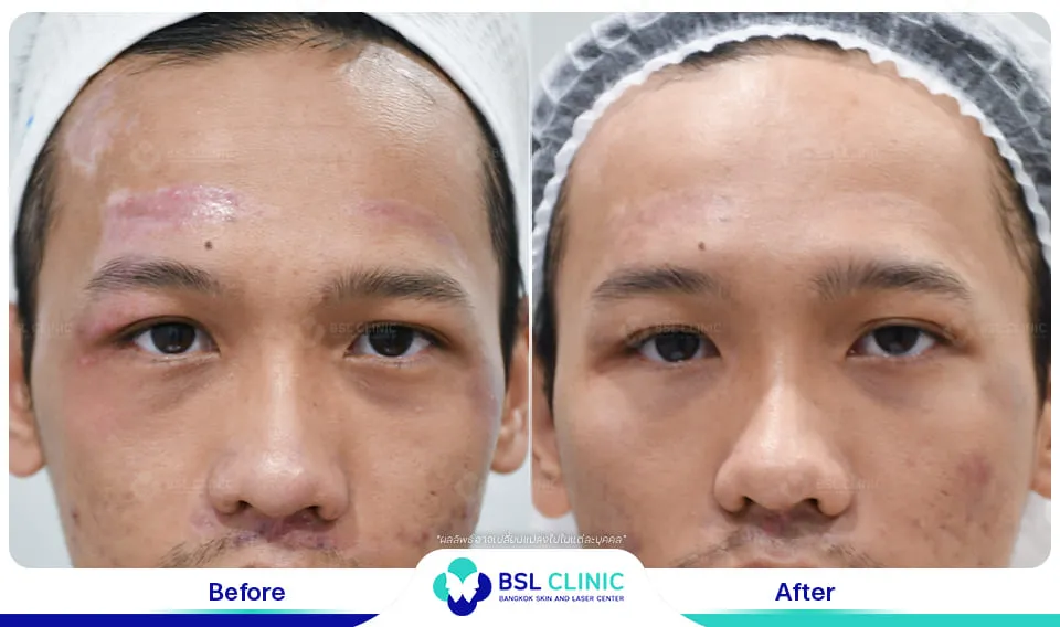 รีวิวรักษาแผลเป็น