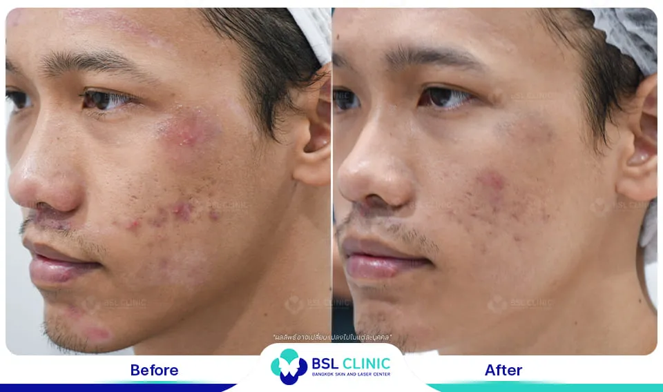 รีวิวรักษาแผลเป็น