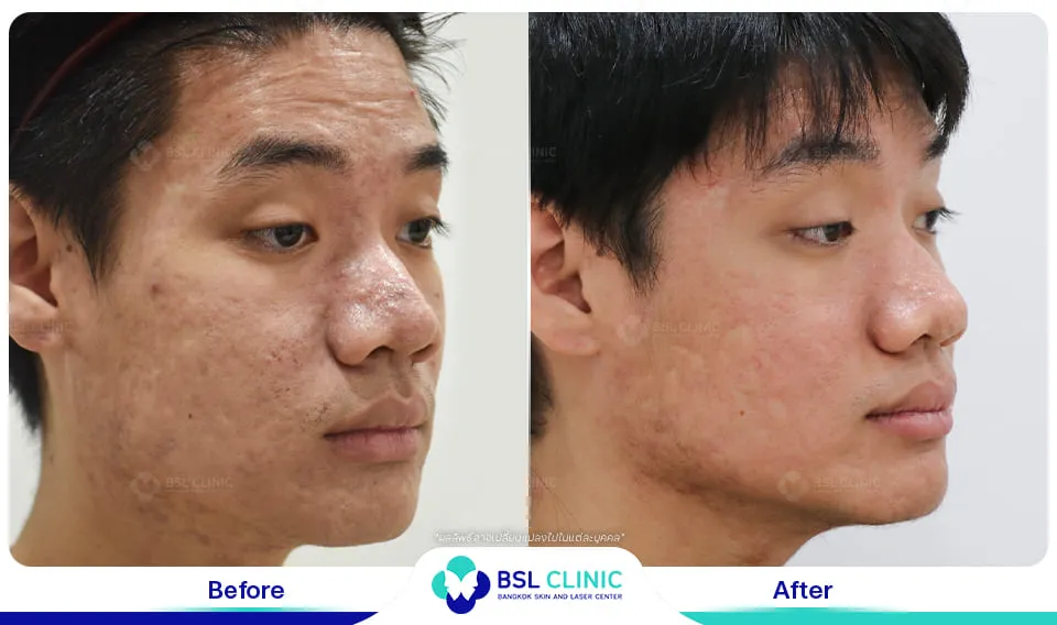 รีวิวรักษาแผลเป็น