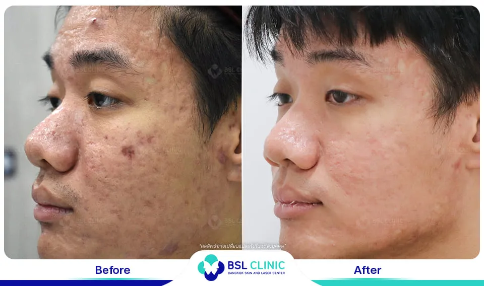 รีวิวรักษาแผลเป็น