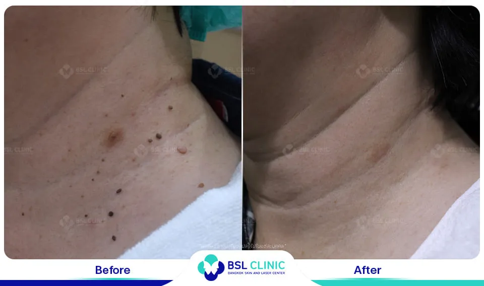 รีวิวเลเซอร์ไฝ