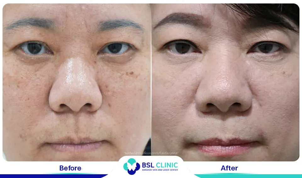 รีวิวเลเซอร์ไฝ