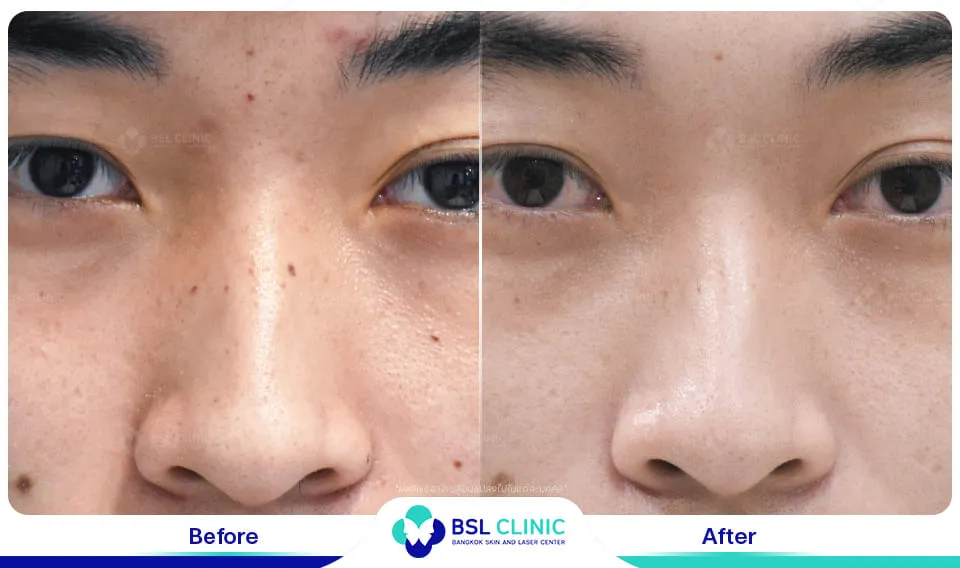 รีวิวรักษาไฝขี้แมลงวัน