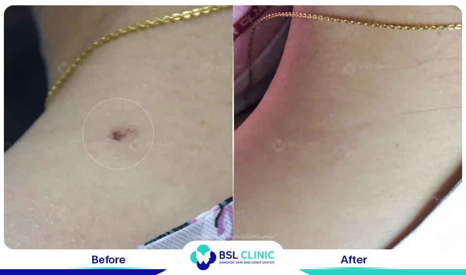 รีวิวรักษาไฝขี้แมลงวัน