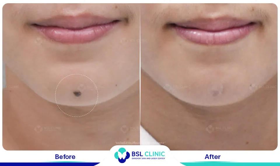 รีวิวรักษาไฝขี้แมลงวัน