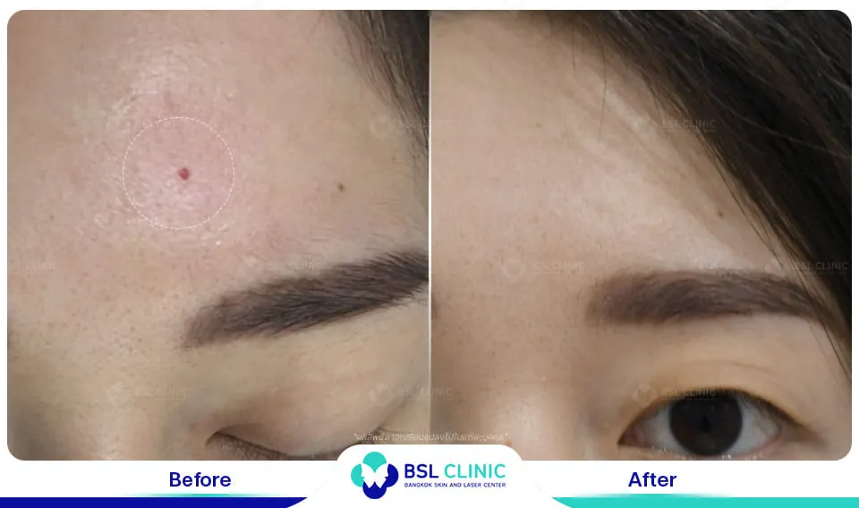 รีวิวรักษาไฝขี้แมลงวัน