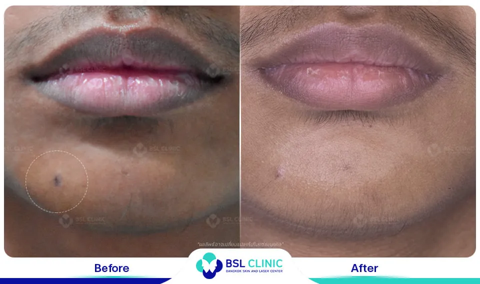 รีวิวรักษาไฝขี้แมลงวัน