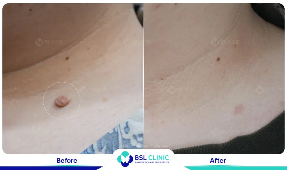 รีวิวรักษาไฝขี้แมลงวัน