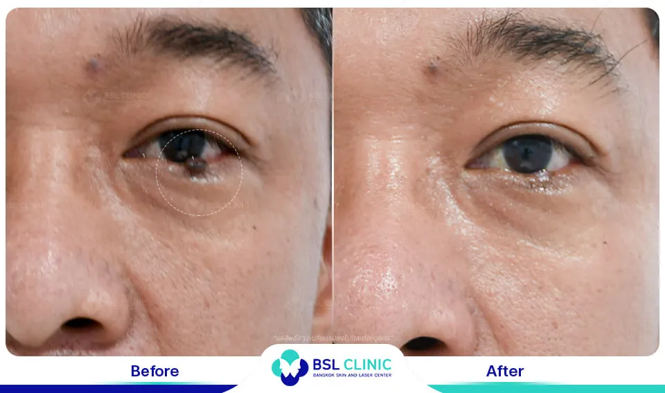 รีวิวรักษาไฝขี้แมลงวัน