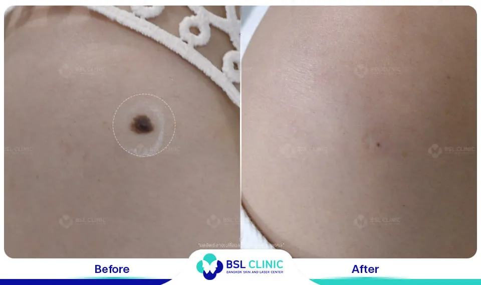 รีวิวรักษาไฝขี้แมลงวัน