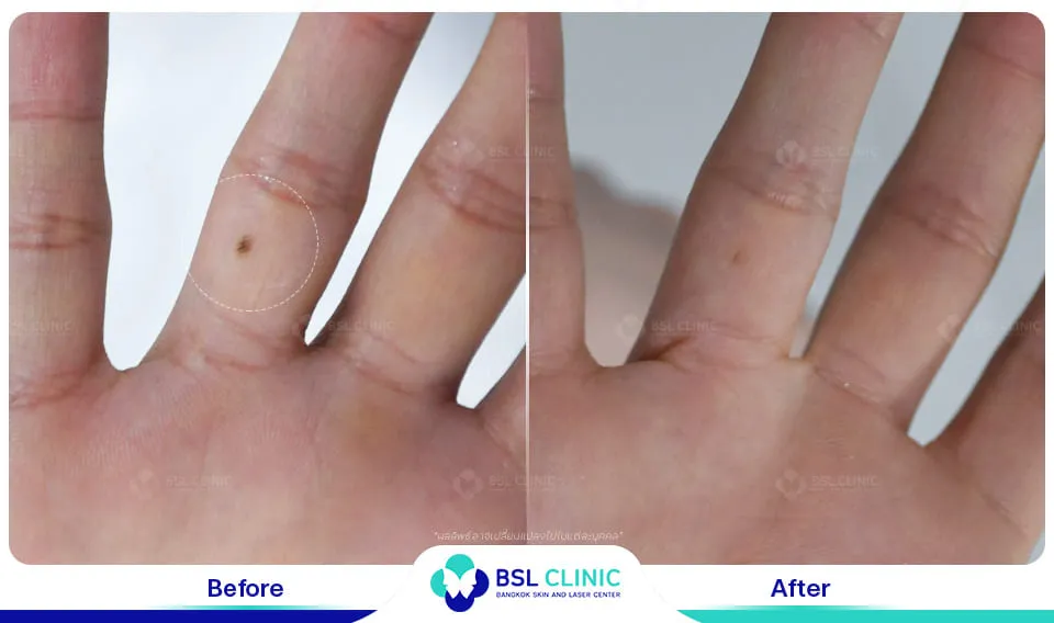 รีวิวรักษาไฝขี้แมลงวัน