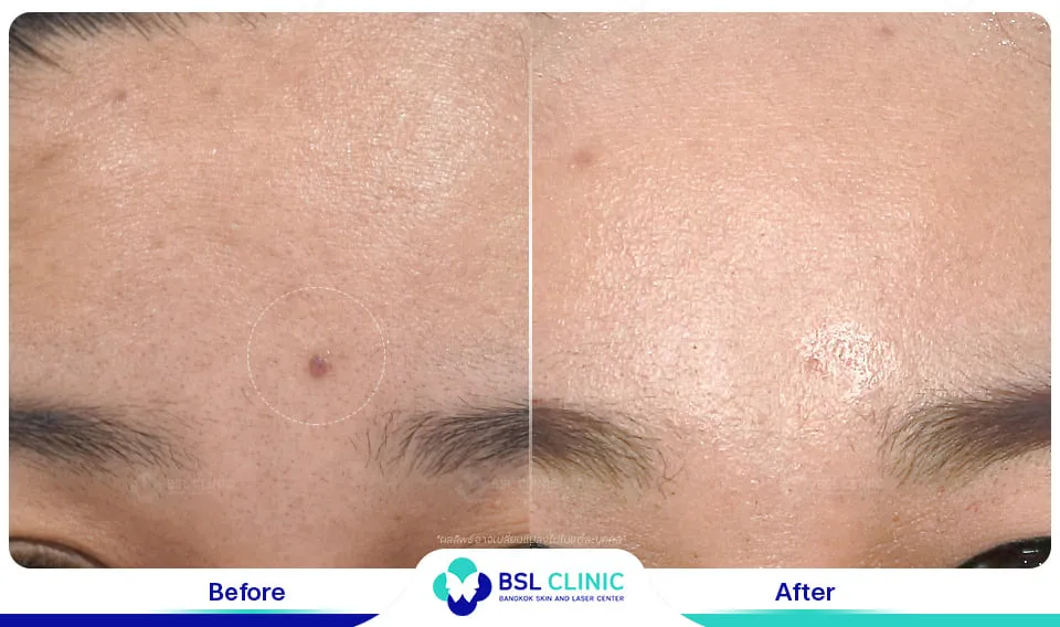 รีวิวรักษาไฝขี้แมลงวัน