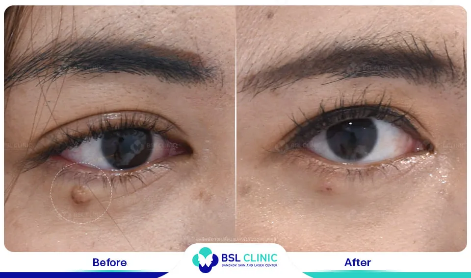 รีวิวรักษาไฝขี้แมลงวัน