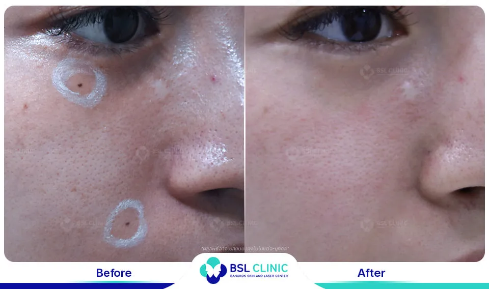 รีวิวรักษาไฝขี้แมลงวัน