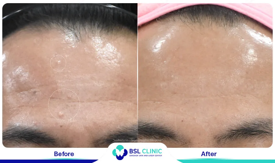 รีวิวรักษาไฝขี้แมลงวัน