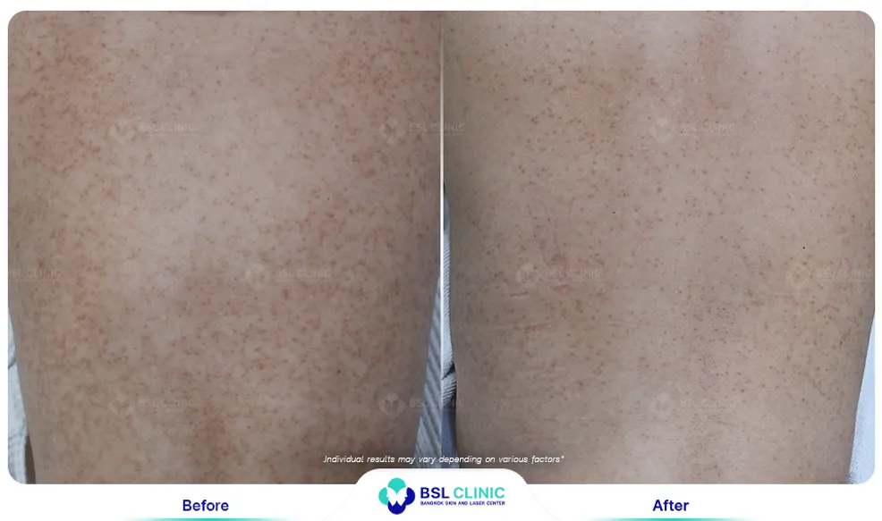 รีวิวรักษาขนคุด