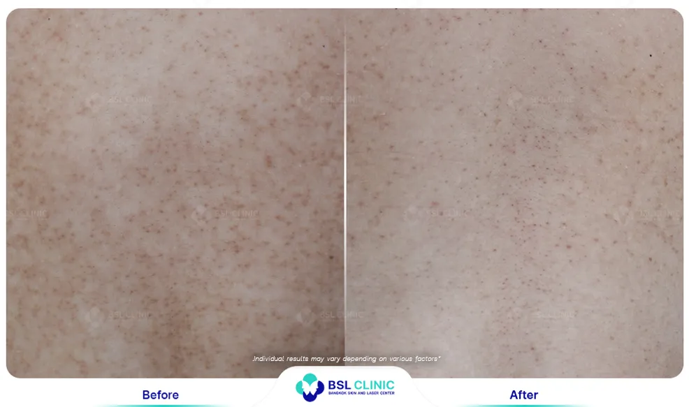 รีวิวรักษาขนคุด