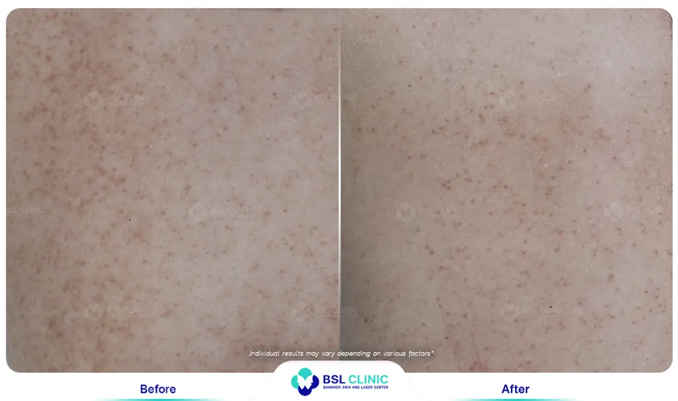 รีวิวรักษาขนคุด