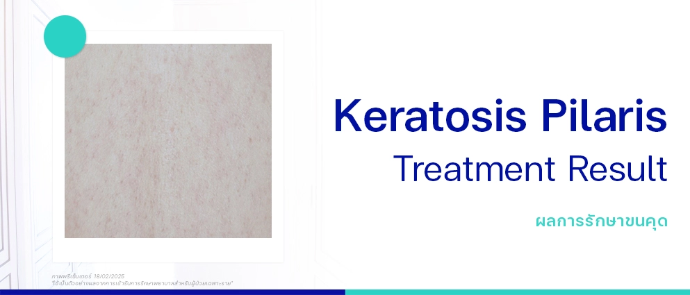 รีวิวรักษาขนคุด