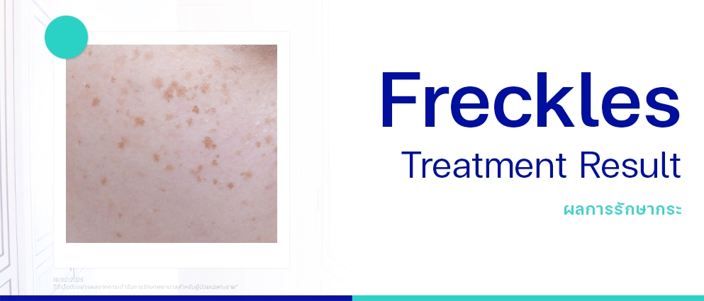 รีวิวรักษากระ