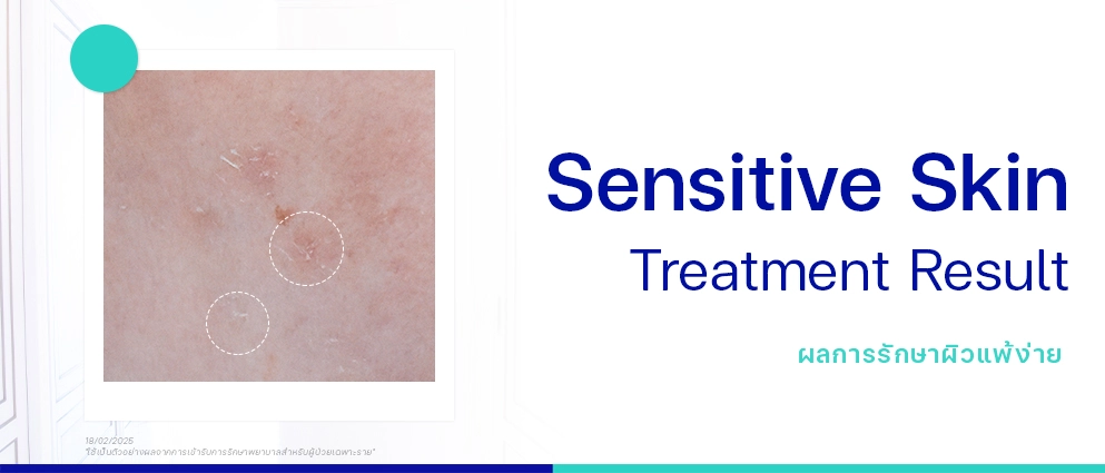 รีวิวรักษาผิวแพ้ง่าย
