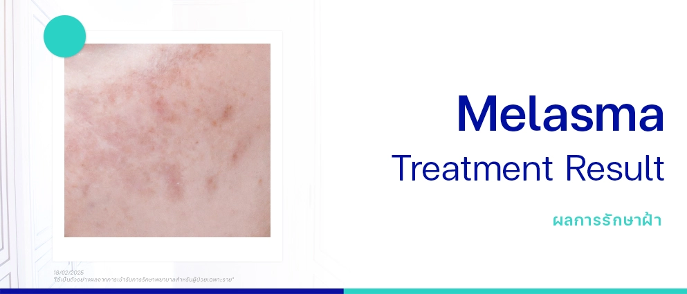 รีวิวรักษาฝ้า