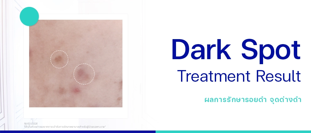 รีวิวรักษารอยดำสิว