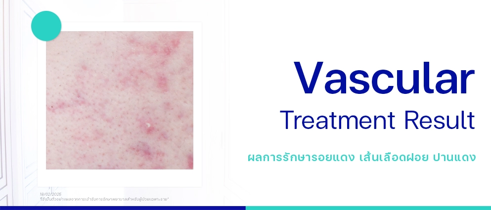 รีวิวรักษารอยแดง