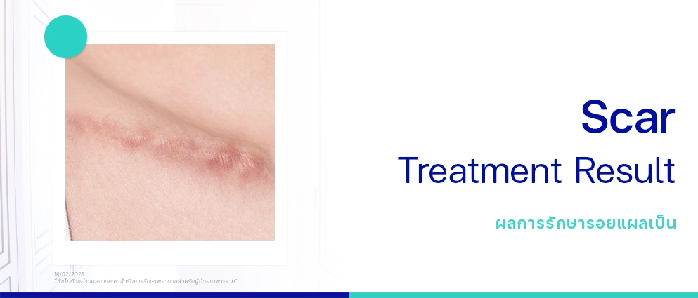 รีวิวรักษาแผลเป็น