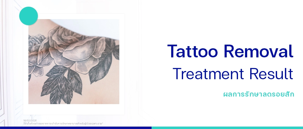 รีวิวลดรอยสัก