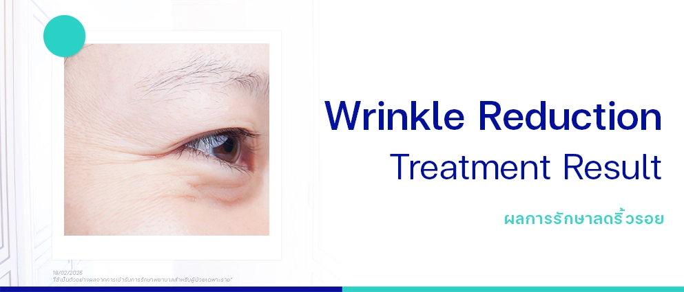 รีวิวลดริ้วรอยร่องแก้ม
