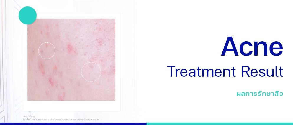 รีวิวรักษาสิว