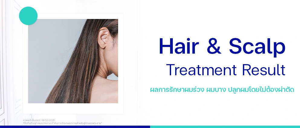 รีวิวรักษาปลูกผม