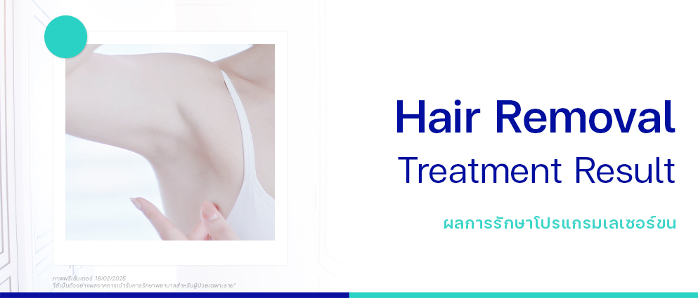 รีวิวเลเซอร์ขน