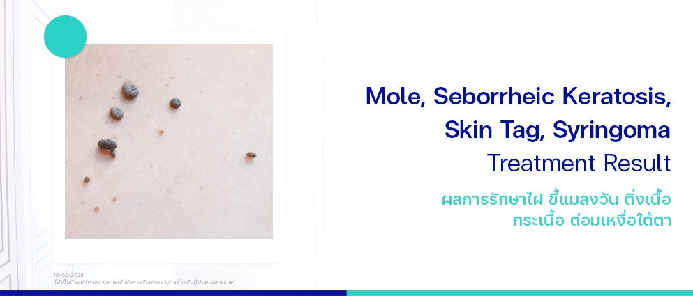 รีวิวรักษาไฝขี้แมลงวัน