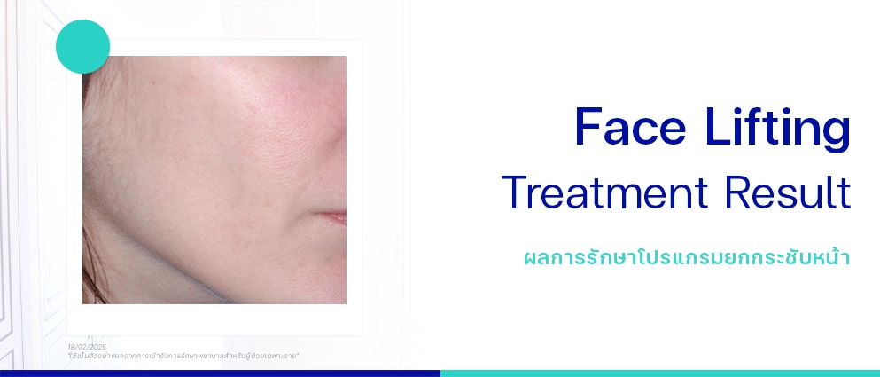 ยกกระชับหน้า