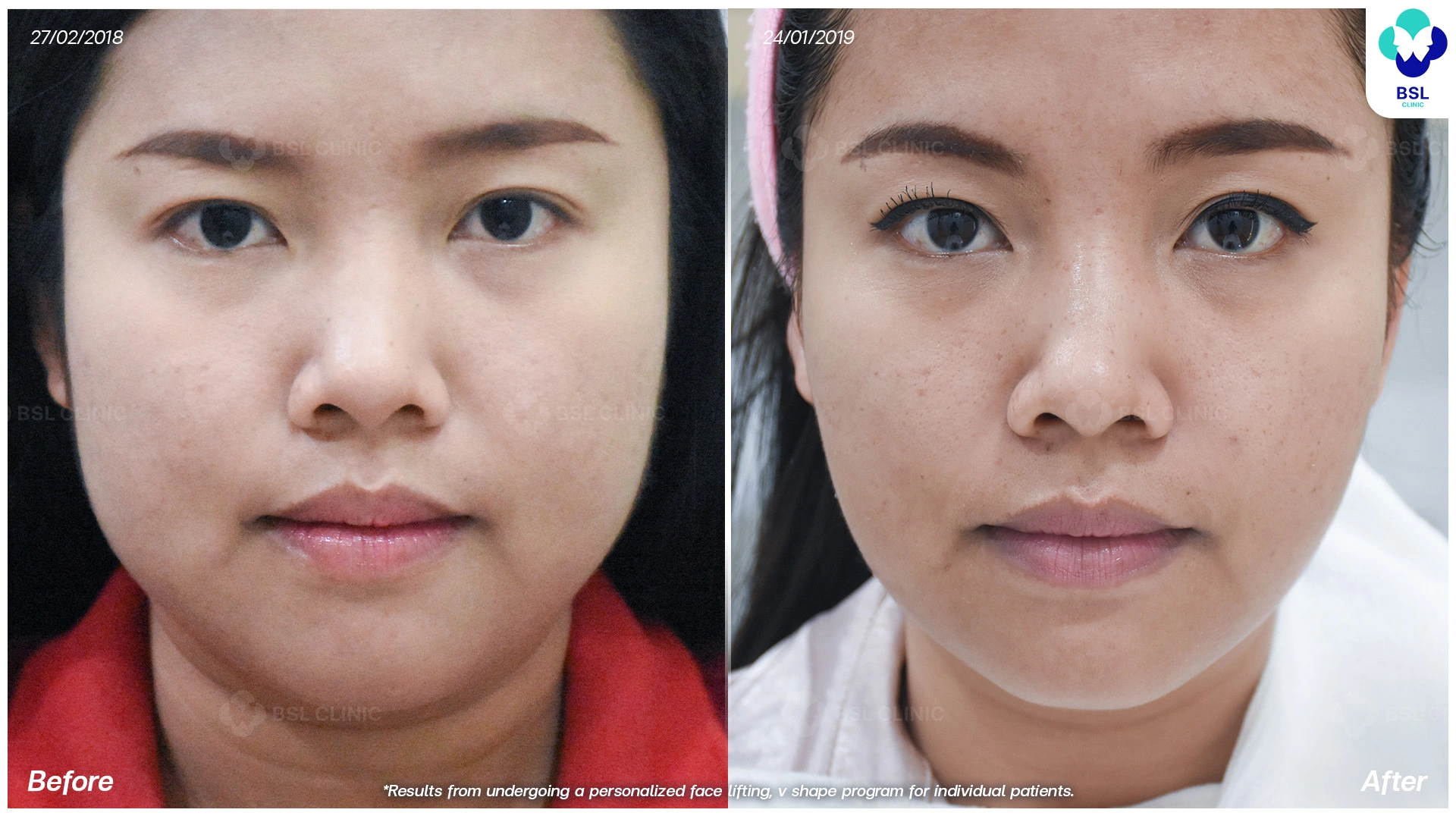 โปรแกรมยกกระชับปรับรูปหน้า